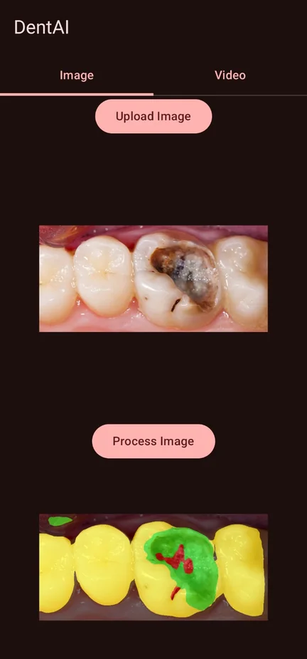 DentAI photo mode: a molar with a large cavity, and the same photo with teeth, cavity and caries masks.