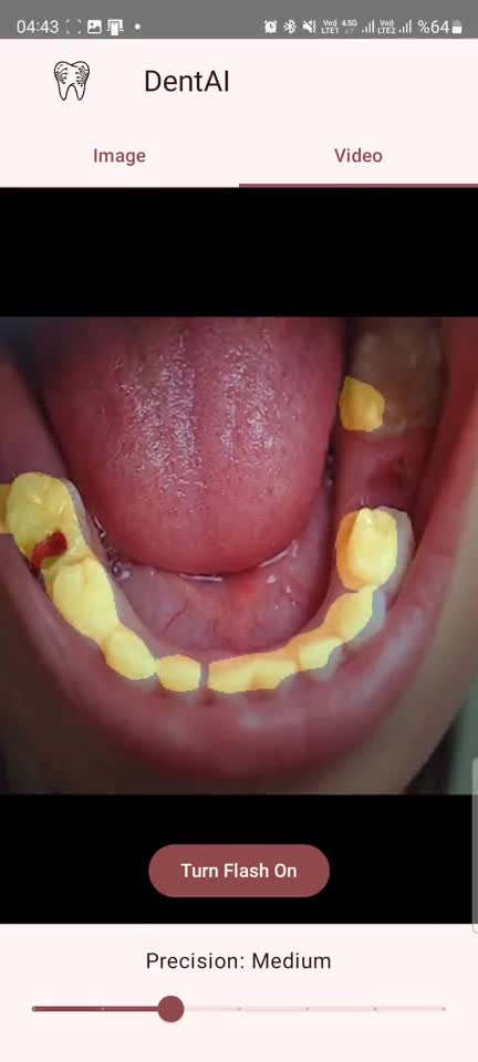 DentAI live mode: teeth highlighted over the camera preview.